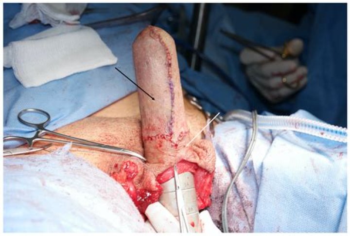 Bruce Jenner Surgery — Has He Had Full Genital Reassignment? – Hollywood Life