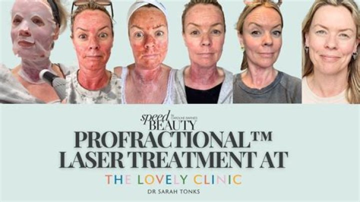 Will $3000 Laser Make You Look Younger? – Hollywood Life