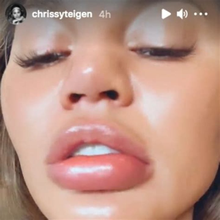 Chrissy Teigen Denies Getting Fillers As She Reveals Extremely Swollen Lips From ‘Biting An Orange’ — Watch