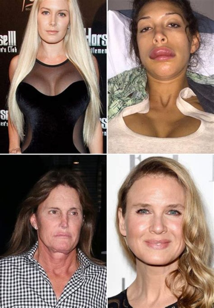 Stars With Botched Procedures – Hollywood Life