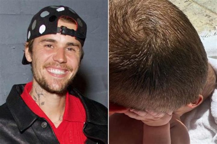 [PIC] Justin Bieber Has Hickeys? Singer Explains Red Marks On Neck – Hollywood Life