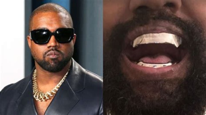 Kanye West Replaces His Teeth With Full Set of $850k Permanent Titanium Teeth
