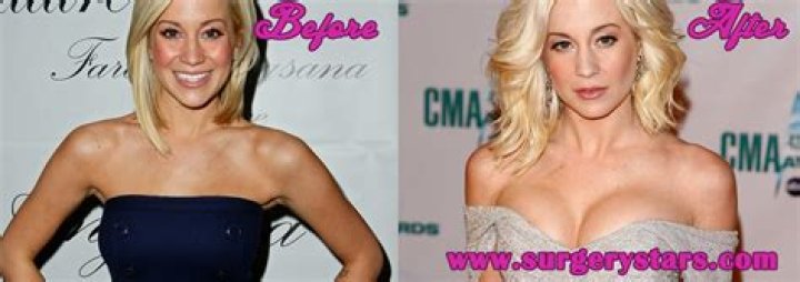 Kellie Pickler Breast Implants Plastic Surgery Before and After