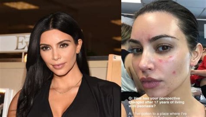 Kim Kardashian: Why It’s Urgent She Works Closely With Her Doc Now That Psoriasis Is On Face