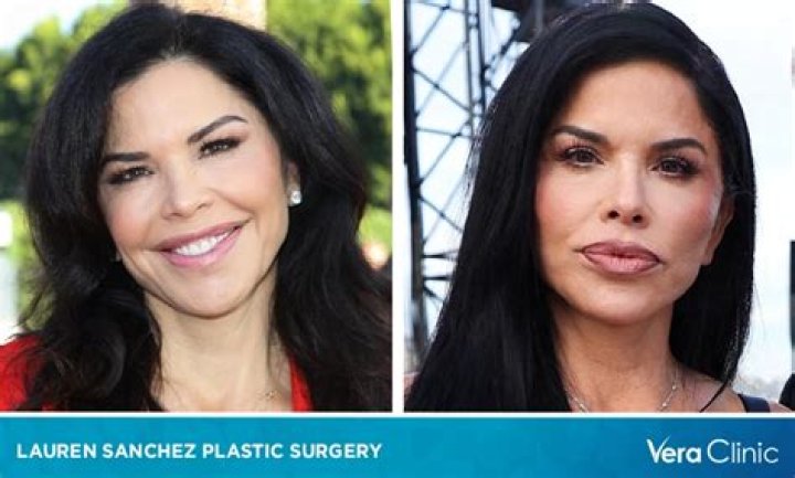 Lauren Holly Breast Implants Plastic Surgery Before and After