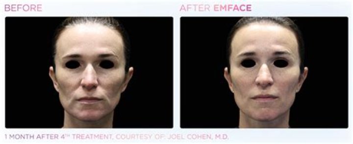 Non Surgical Facelift Jessica Simpson Tried – Hollywood Life