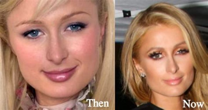 Paris Hilton Nose Job Plastic Surgery Before and After