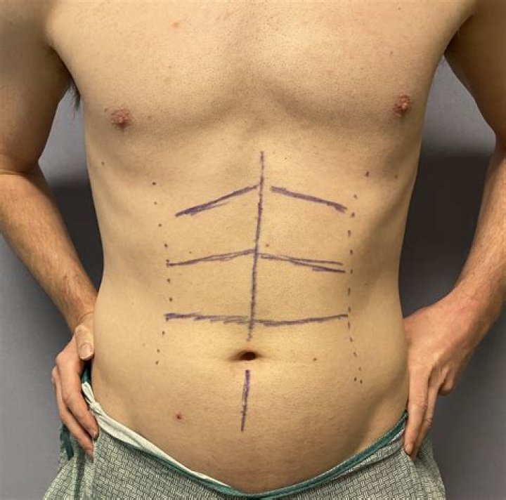 Are Pauly D’s Abs Due To Plastic Surgery? Doctor Explains – Hollywood Life