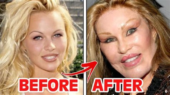 [PHOTOS] Plastic Surgery Gone Wrong — Celeb Pics – Hollywood Life
