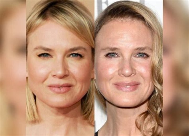 Renee Zellweger Lip Injections — The Actress Steps Out With Very Different Face – Hollywood Life