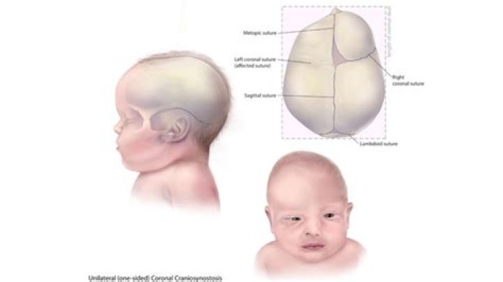 Teddi Mellencamp’s Baby Dove, 4 Mos.: Why Her Neurosurgery For Lambdoid Craniosynostosis ‘Isn’t Complicated’